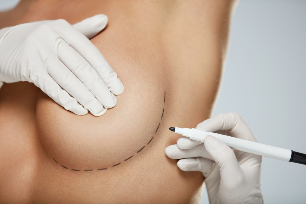 Aumento mamario | Dr. Ariel Emilio Guerrero | Cirujano plástico